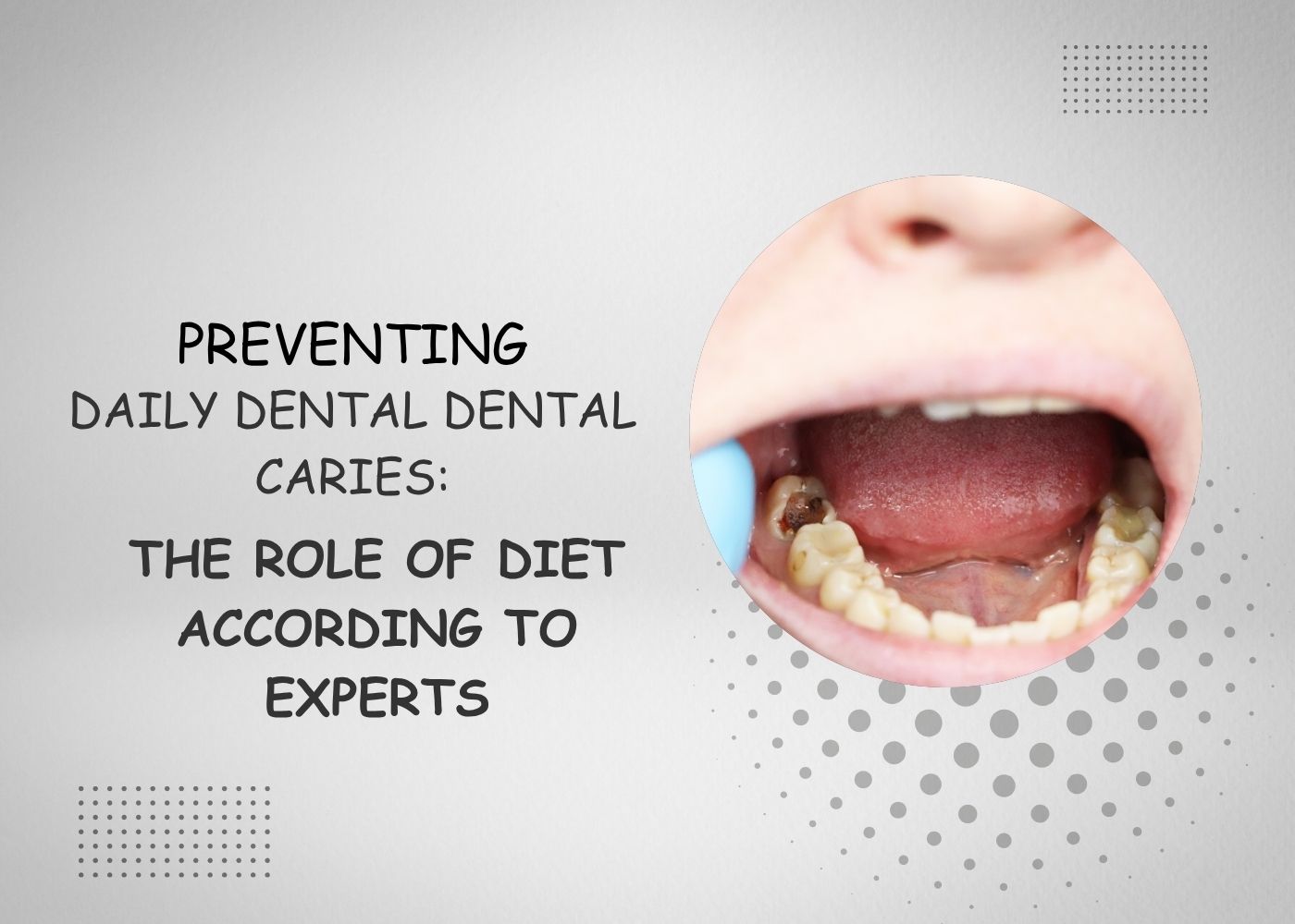 Preventing Dental Caries: The Role of Diet According to Experts