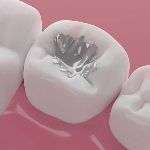 Kids Dental Fillings In Gurgaon.jpg